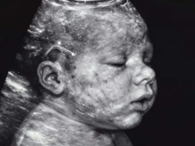 Jak se pozná Downův syndrom na ultrazvuku?